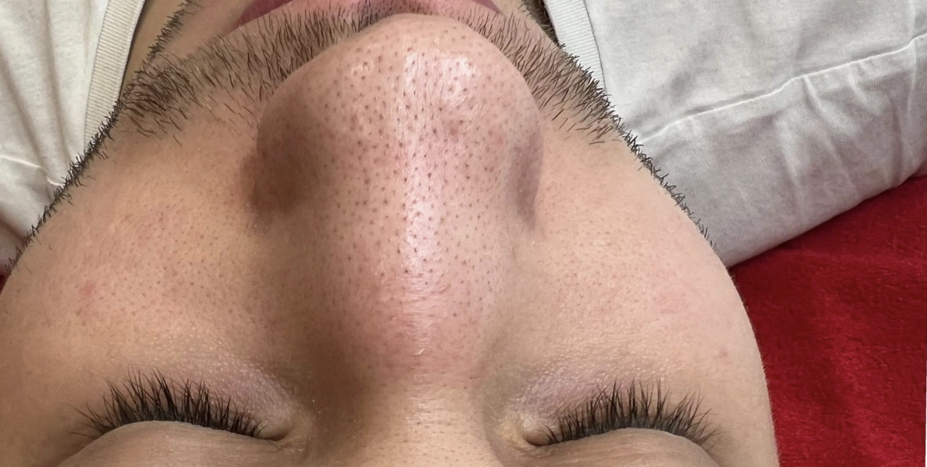 Prieš veido valymą